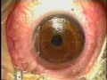 laserova operace oka (pog) - Známka: 4, váha: střední