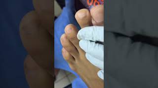 Ep_8165 Foot nail skin removal 👣 Wow..it came out in lumps 😄 (clip from Thailand)