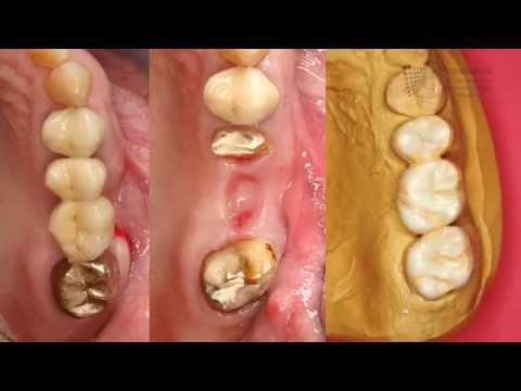 Kronen und Brücken - Ästhetischer Zahnersatz für beschädigte Zähne | Implantatzentrum Nymphenburg