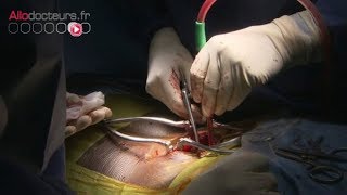 Hernie discale : la chirurgie, ultime recours - Allô Docteurs