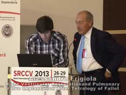 Alessandro Frigiola, Right Ventricular Restoration and Pulmonary Valve Implantation

