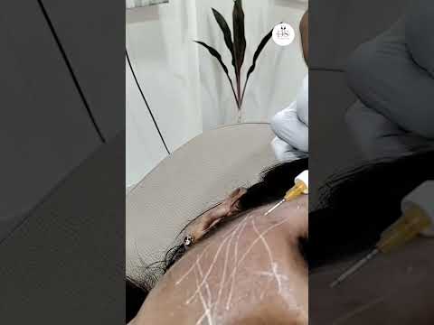 cheeks fillers cheek volume