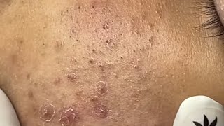 Relaxing Acne Cleansing with LinhMyDang #576 P3