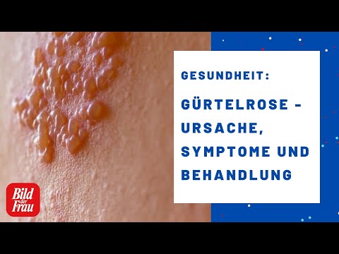 Gürtelrose: Ursache, Symptome und Behandlung | BILD der FRAU