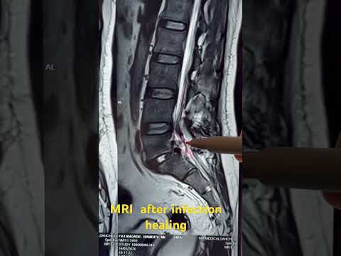 How does healing of spine infection looks on MRI