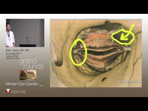 Optic Nerve Sheath Fenestration for IIH Video