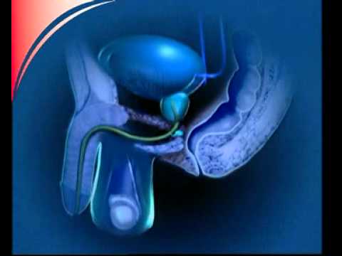 Prostatitis Ätiologie Pathogenese Wie Prostata-Soda heilen