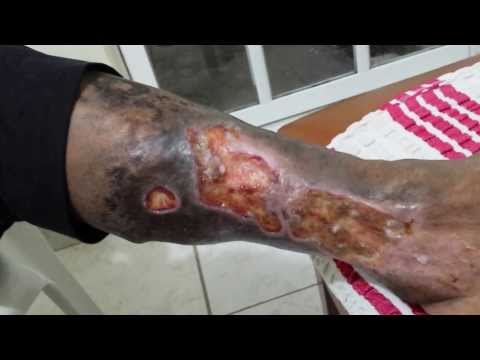 Dermatite di atopic per esercito Il sale vive in caverne a dermatite atopic