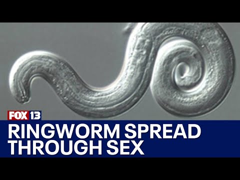 First U.S. case of sexually transmitted ringworm | FOX 13 Seattle