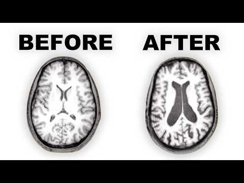 Long-term Effects of Antipsychotics on the Brain