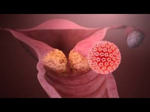 Chemotherapy drugs for hpv throat cancer