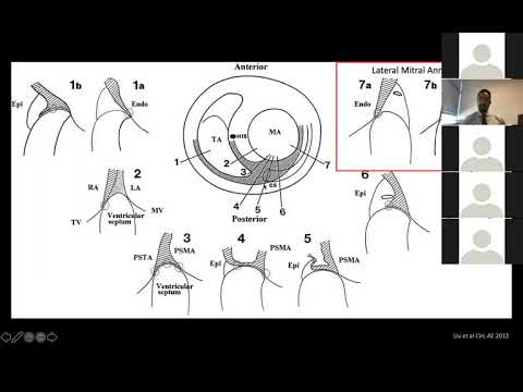 6 11 20 Ehdaie Electroanatomical considerations for the catheter ablation of accessory pathways