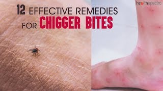 12 Effective Remedies For Chigger Bites | Healthspectra