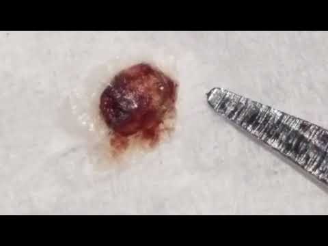 Morgellons Lesion Scab Filled with Morgies...Luminescent Flashing White Lights & Defensive Moves