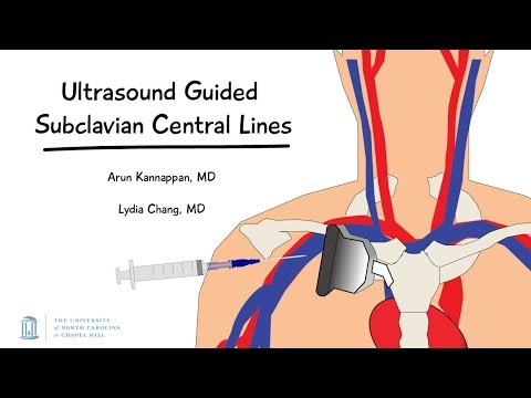 Ultrasound Guided Subclavian Central Lines -- BAVLS