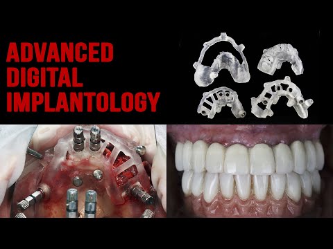 All on Four - lower and upper jaw - Multicomponent templateIntra - intraoral welding