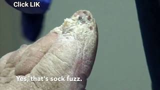 Thickest Callus Removal - Callus Removal &amp; RESTMORE 👍👍👍👍👍