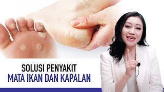 Download lagu Mata Ikan dan Kapalan Bikin Kulit Keras, Ini Penyebab dan Cara Mengatasinya | Kata Dokter mp3 Download lagu Mata Ikan dan Kapalan Bikin Kulit Keras, Ini Penyebab dan Cara Mengatasinya | Kata Dokter mp3