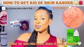 HOW TO GET RID OF SKIN RASH/HEAT RASHES: Heat Rash On Baby + 5 Effective Ways to treat Heat Rashes
