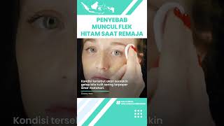 Penyebab Remaja Muncul Flek Hitam yang Jarang Diketahui: Hormonal hingga Salah Pakai Skincare