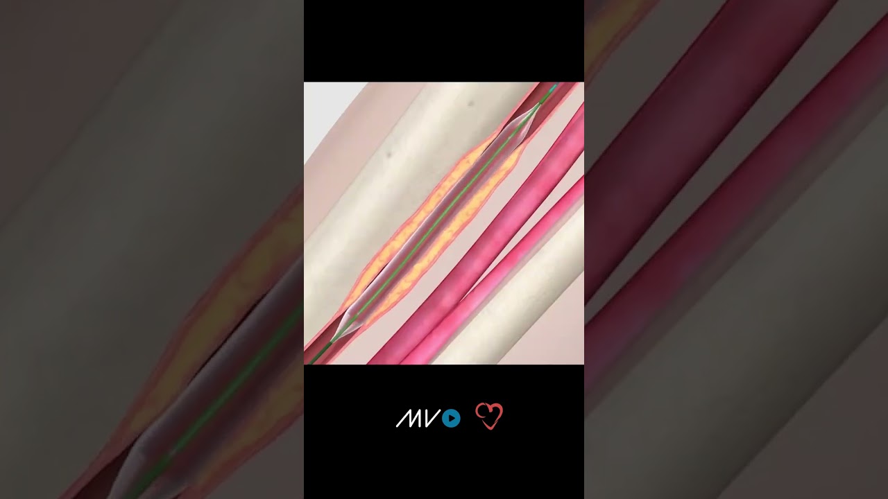 Balloon Angioplasty - Animated Video
