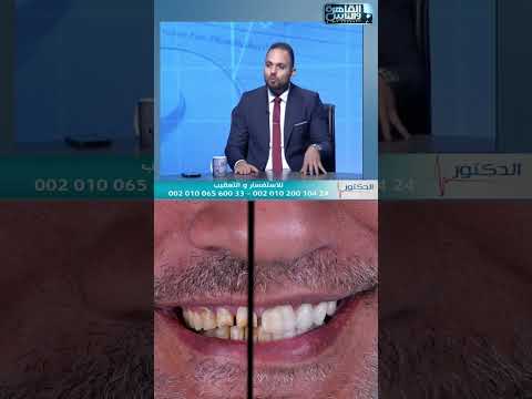 مقابلة — العمر الافتراضي للفينير
