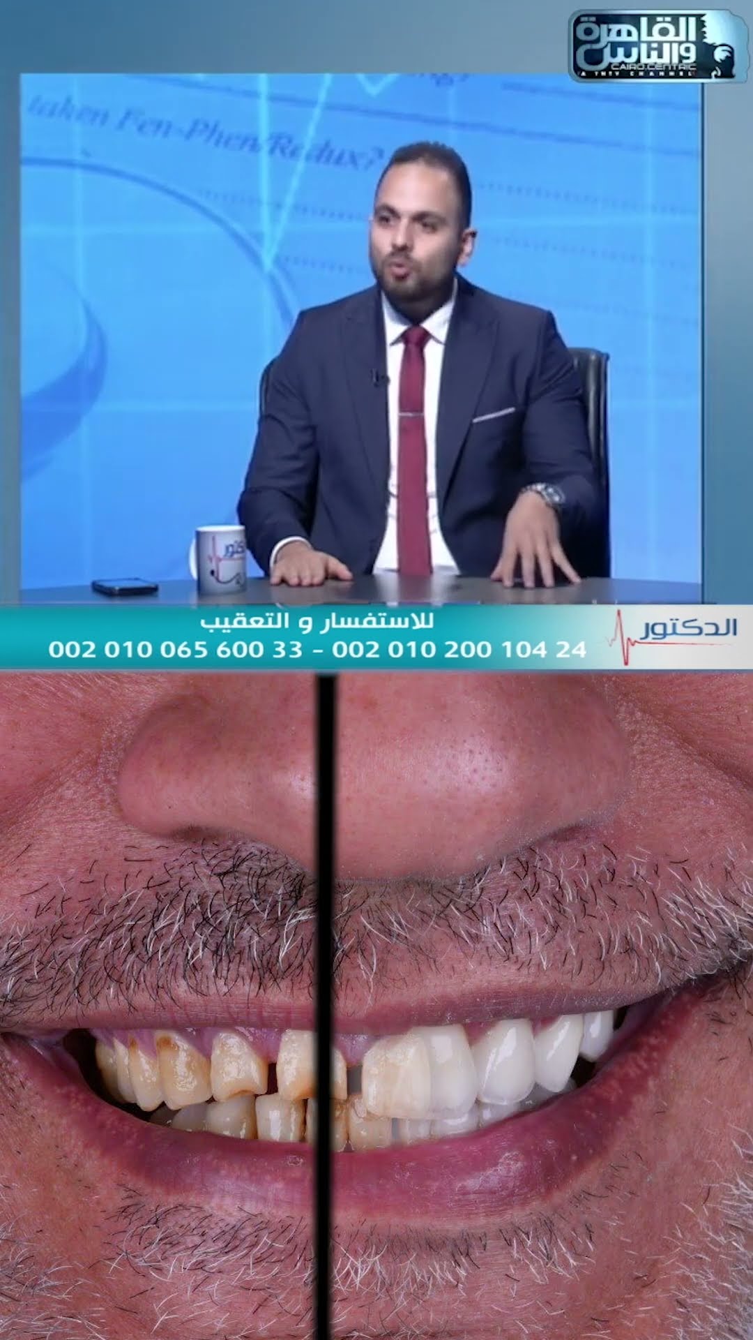 مقابلة — العمر الافتراضي للفينير