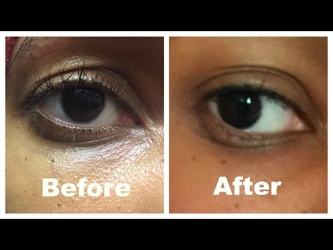 How I corrected my saggy  hooded eyelid (without surgery) Video