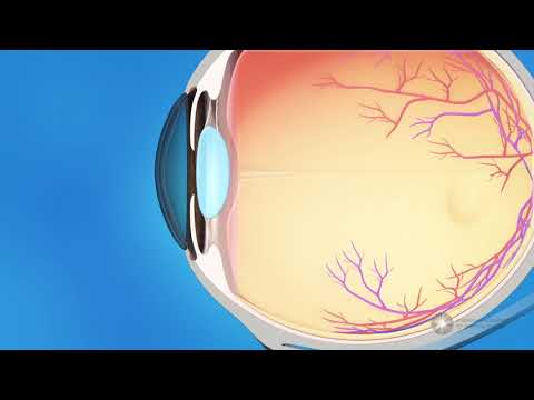 Ce este glaucomul (tensiunea oculară)? Simptome și tratament