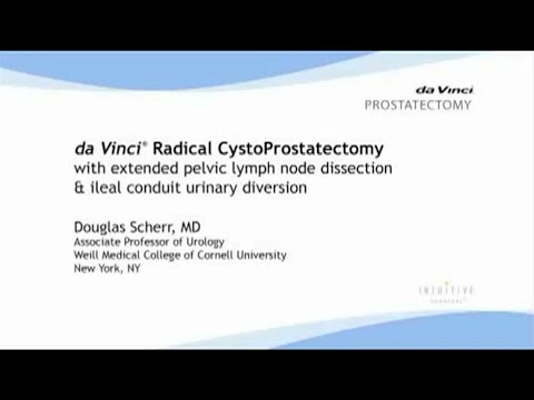 daVinci Radical CystoProstatectomy with extended pelvic lymph node dissection and ileal conduit urinary diversion