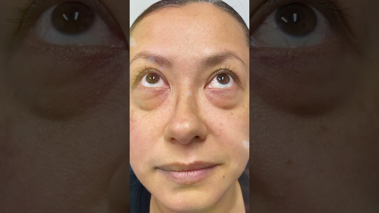 Blefaroplastia inferior con transposición de grasa orbitaria