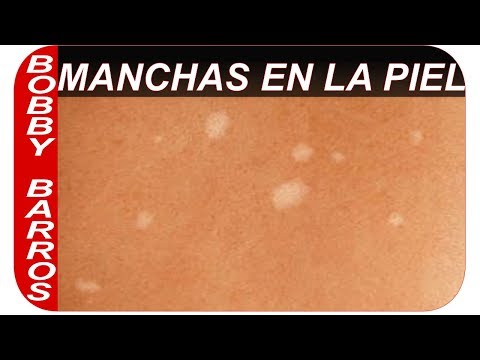 download lagu mp3 mp4 Manchas Blancas En La Espalda, download lagu Manchas Blancas En La Espalda gratis, unduh video klip Manchas Blancas En La Espalda