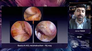 Basics in ACL Reconstruction – My way