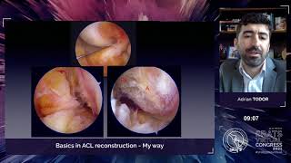 Basics in ACL Reconstruction - My way