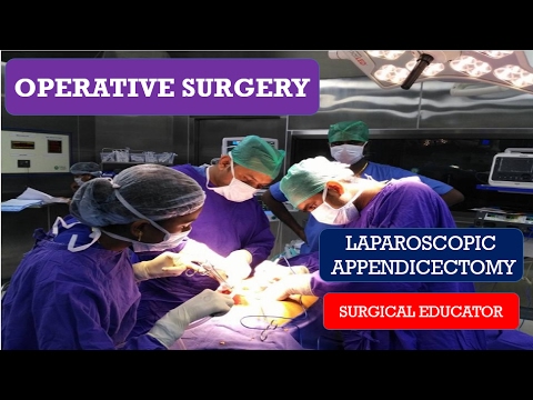 LAPAROSCOPIC APPENDICECTOMY- STEP BY STEP Operative Surgery