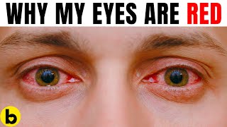 13 Reasons Why Your Eyes Are Always Red