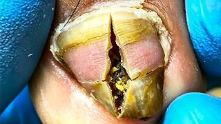 Give Your Toenails A Thorough Trim And Cleaning!【Xue Yidao】
