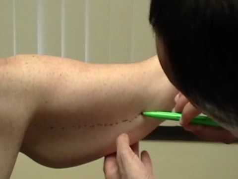 video Armlift thumbnail