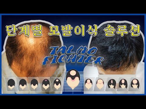 탈모 스트리트파이터 | 모발이식, 내 머리는 얼마면 돼?