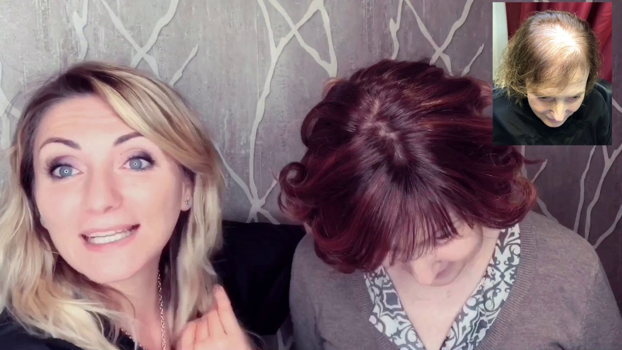 Capelli Diradati Un buon sistema per l'infoltimento  non invasivo 