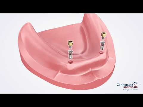 Behandlungsablauf: Locatorprothese - Zahnersatzsparen.de