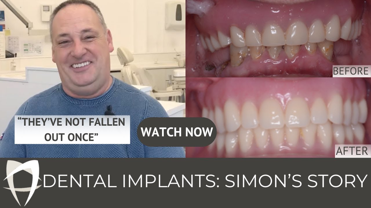 Simon - Implant-Retained Dentures (Lower) + Complete Denture (Upper)