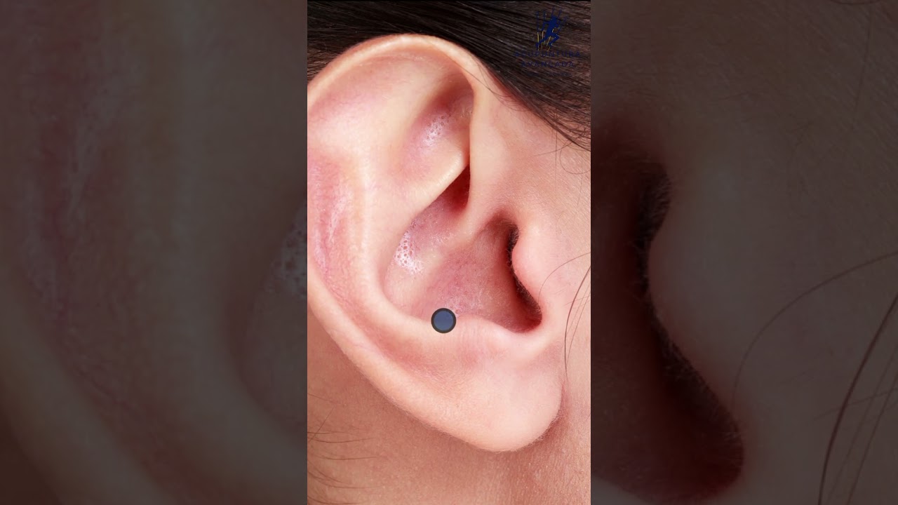 Acupuntura para enxaqueca