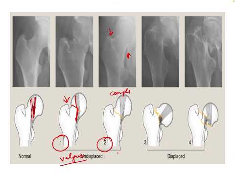 Neck of femur fracture Classification