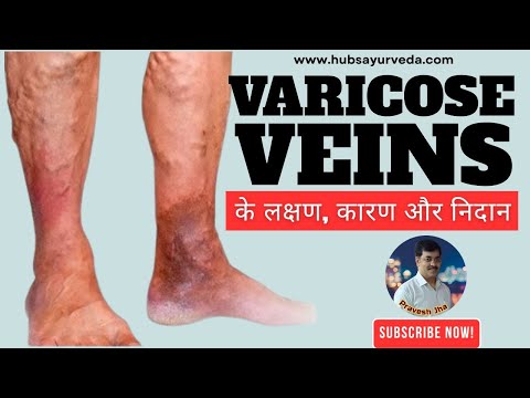 Hubs Ayurveda Varicoz Capsules