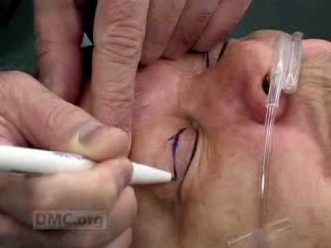 "Drooping Eyelid" Repair Surgery Video