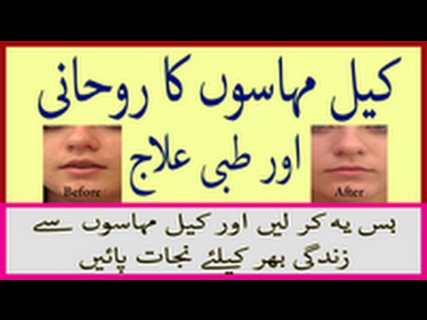 Beauty Tips For Acne And Pimples - Keel Mahasay Khatam - Acne And Pimples Treatment - کیل مہاسے ختم Video