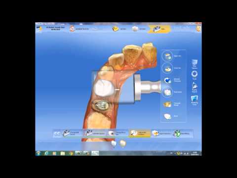 CEREC CROWNS STEP BY STEP USING IPS E.MAX CAD BLOCKS