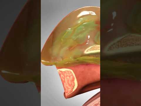 What does a Sinus Infection look like?  #anatomy #sinusinfection #nose