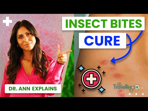 Insect Bites: Treatment, Home Remedies & When to See a Doctor (Doctor Explains)